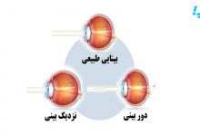 نزدیک بینی چشم و دوربینی چشم