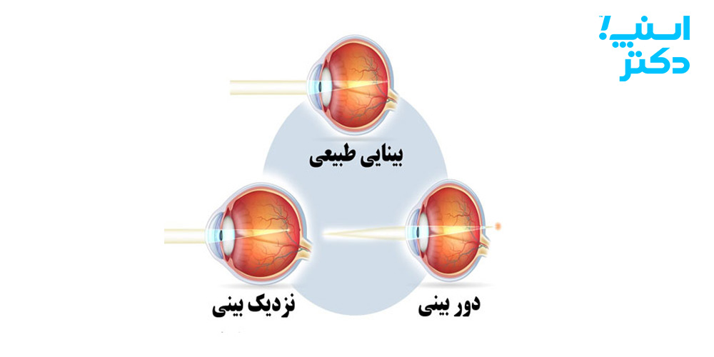 نزدیک بینی چشم و دوربینی چشم