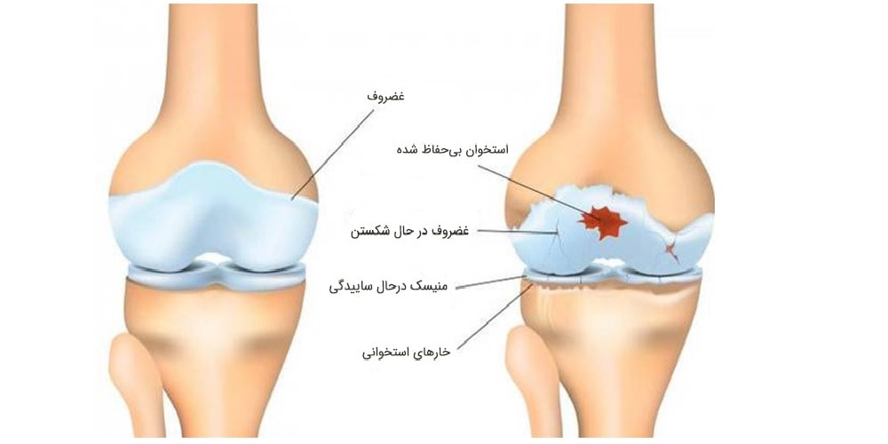 آرتروز چیست