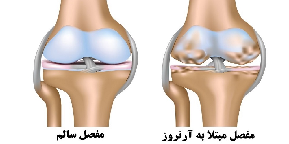 بیماری آرتروز 