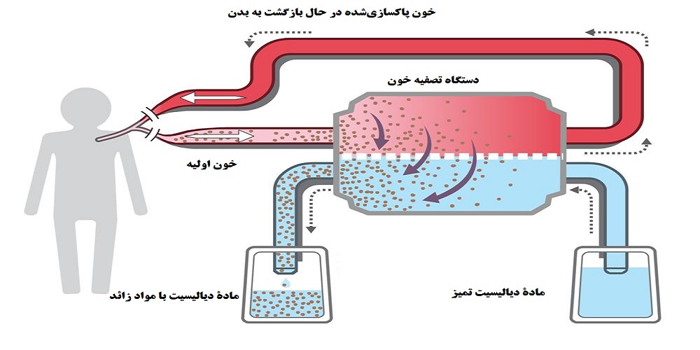 دستگاه تصفیه خون