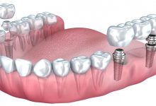 ایمپلنت دندان چیست؟