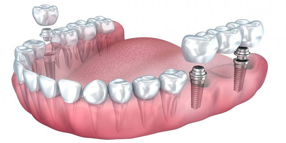 ایمپلنت دندان چیست؟