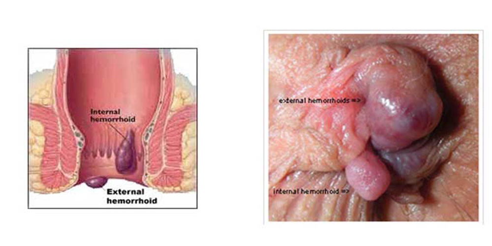درمان بواسیر