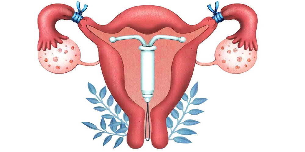 پیشگیری اورژانسی از بارداری (IUD)