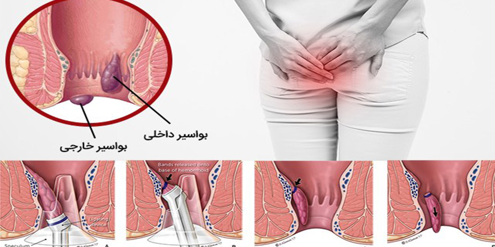 درمان بواسیر