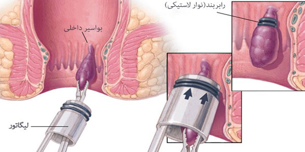 بواسیر چیست؟