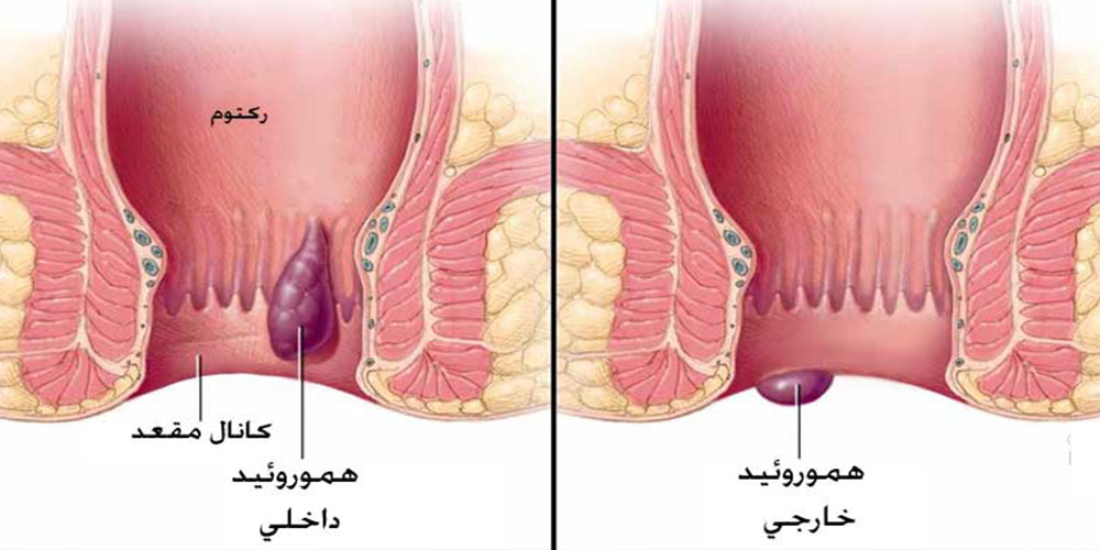 بواسیر چیست؟