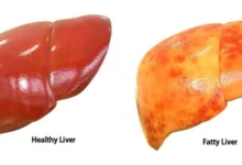 علائم کبد چرب و روش‌های درمان آن