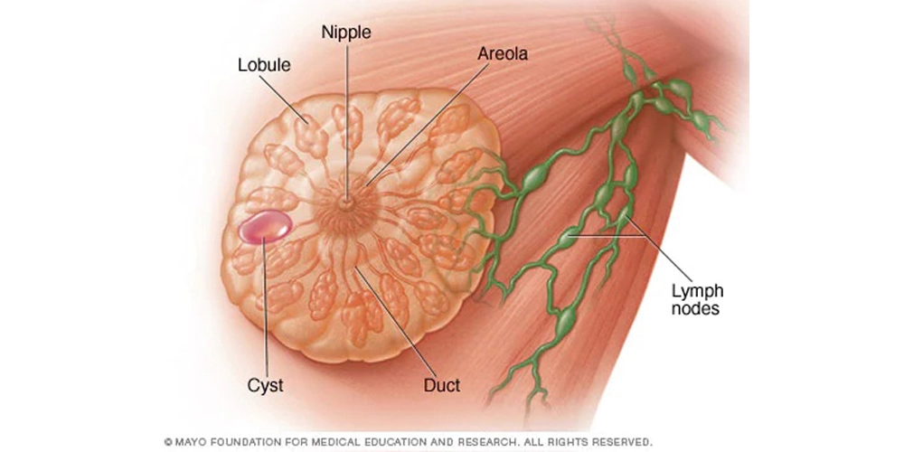 کیست سینه