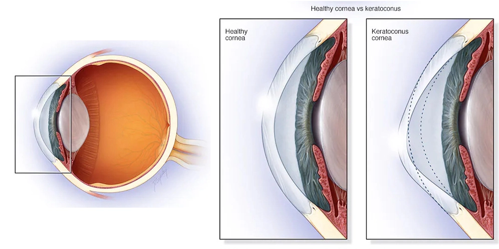 عوارض قوز قرنیه چیست؟