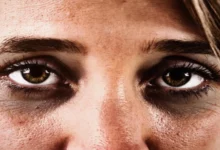 تصویر دلایل تیرگی و سیاهی دور چشم چیست؟ 