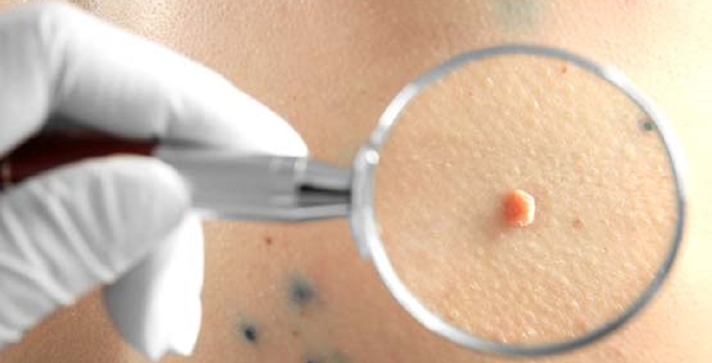 genital warts in men 