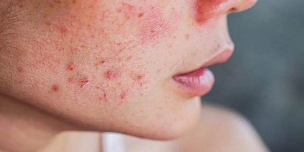 آندروژن بیش از حد