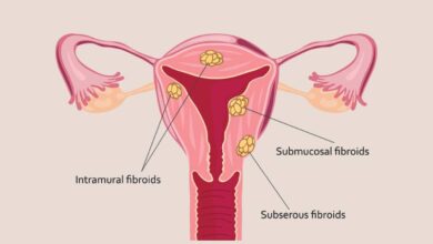 همه چیز درباره فیبروم رحم که باید بدانید!