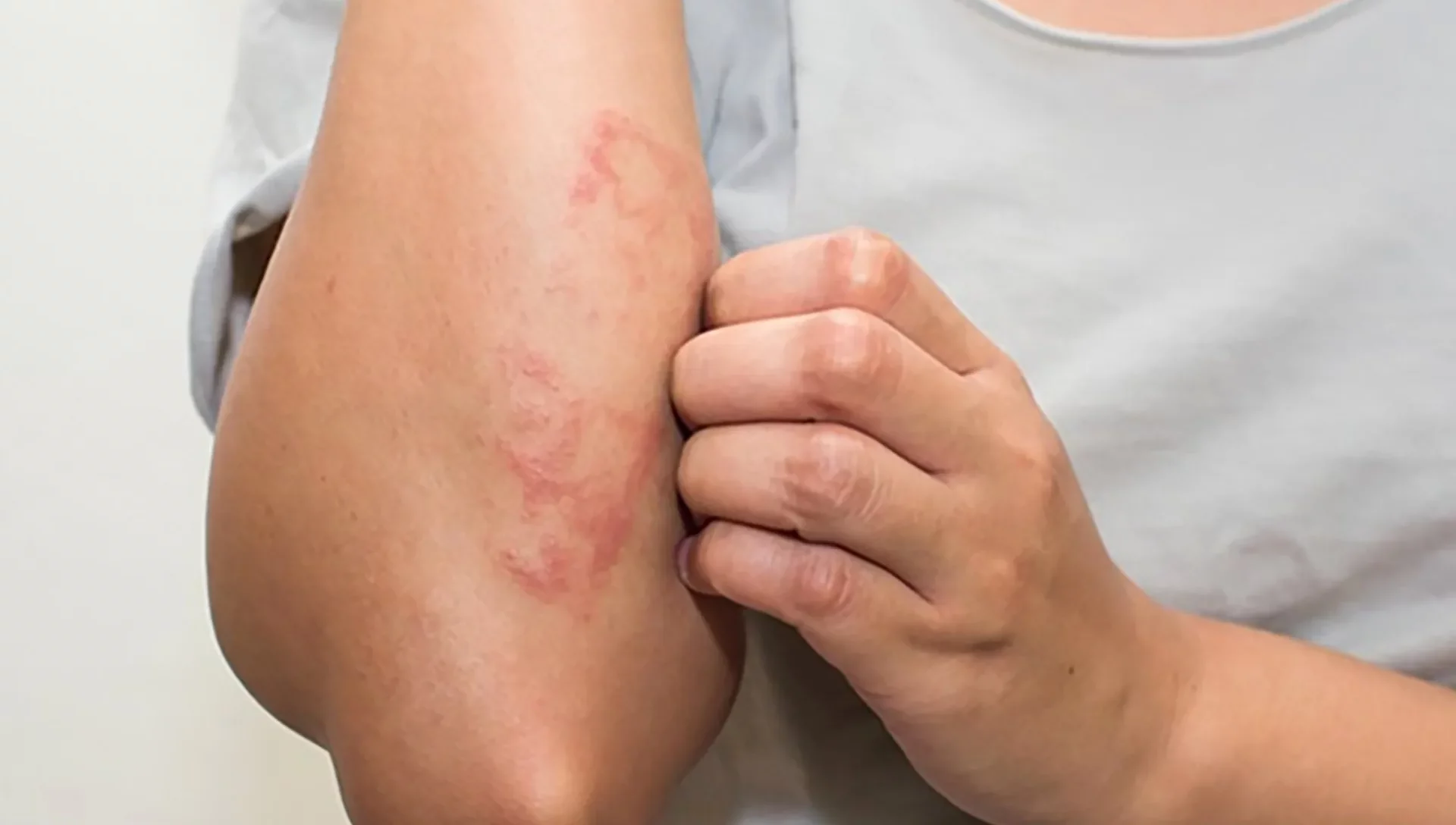 آنافیلاکسی یکی از عوارض داروی فشارخون لیزینوپریل