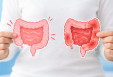 تفاوت IBS و IBD چیست؟