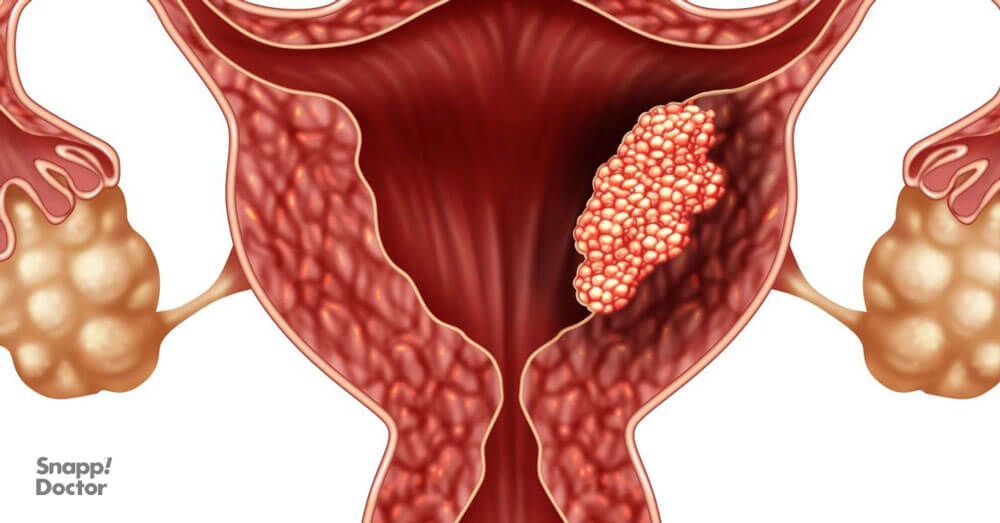 داروی جستیران برای کارسینوم اندومتر رحم مورد استفاده قرار می گیرد
