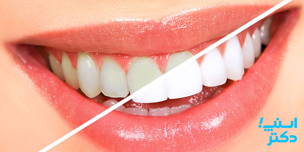 علت زرد شدن دندان