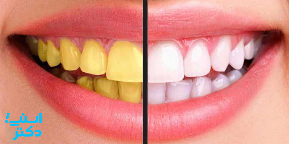 زرد شدن دندان