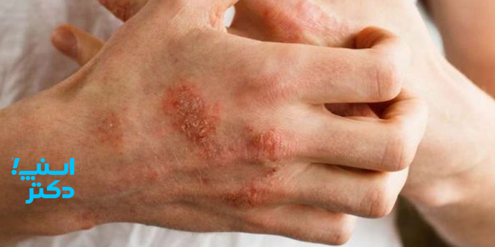 عفونت های انگلی